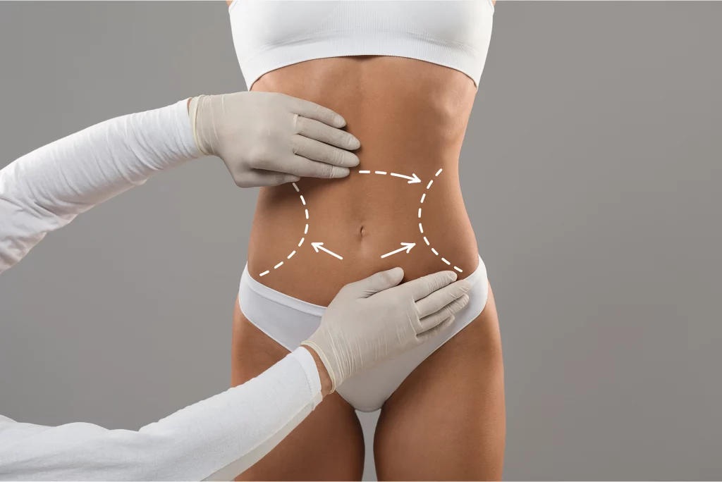 Abdominoplastia